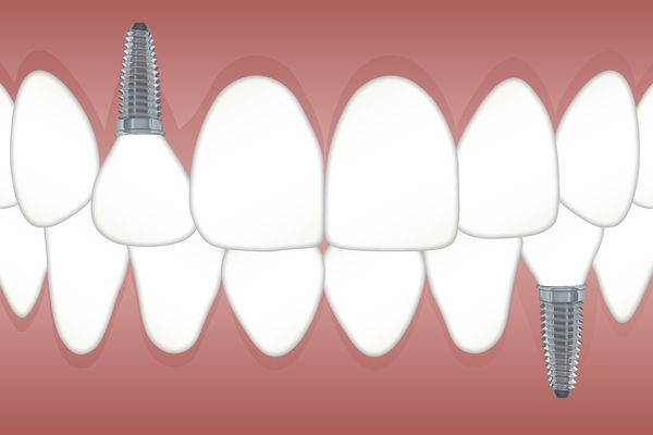 ¿IMPLANTES BARATOS? ¡NO GRACIAS!